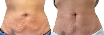 Morpheus8® Before & After Gallery - Patient 137790 - Image 1