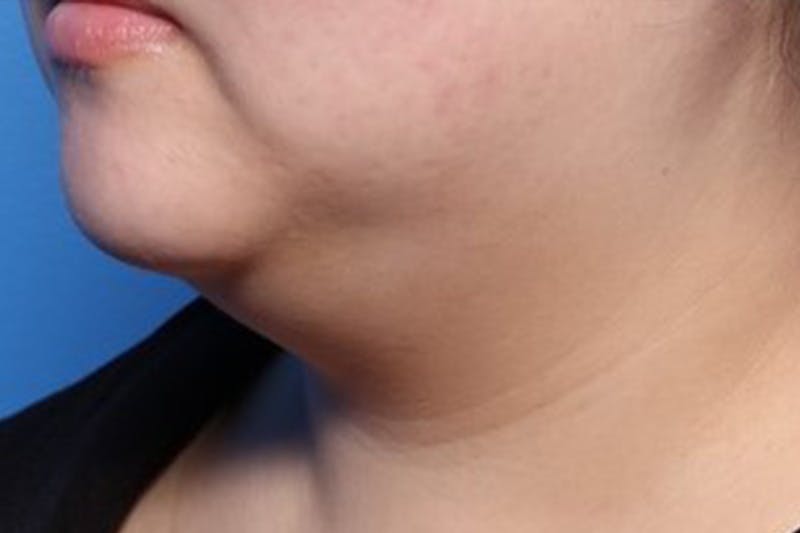 FaceTite Before and After Before & After Gallery - Patient 248896 - Image 3