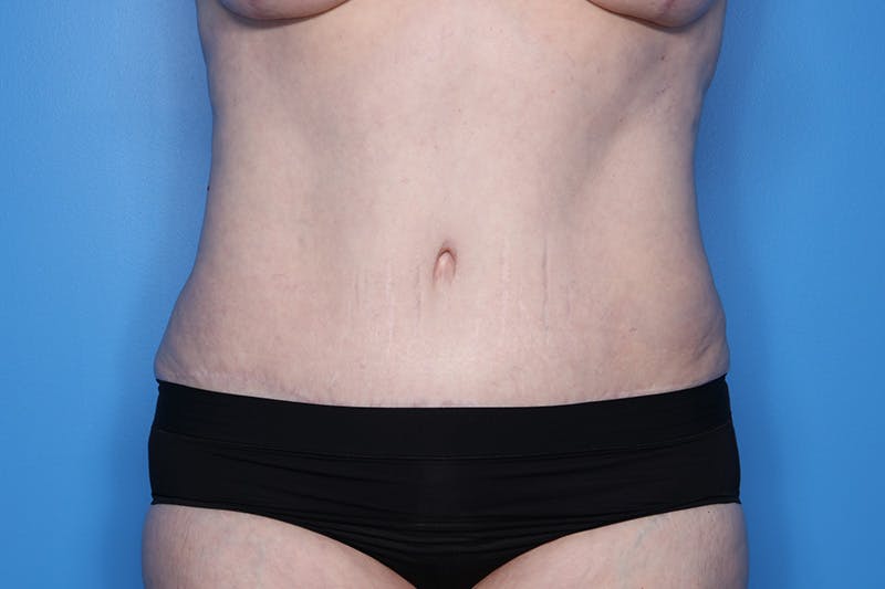 Tummy Tuck Before & After Gallery - Patient 268321 - Image 2