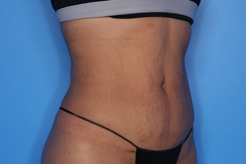 BodyTite™ Before and After Before & After Gallery - Patient 258169 - Image 4