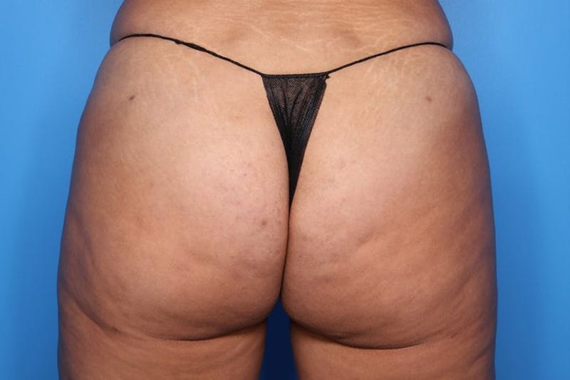 Liposuction Before & After Gallery - Patient 133045 - Image 2