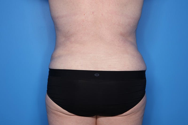 Tummy Tuck Before & After Gallery - Patient 268321 - Image 6