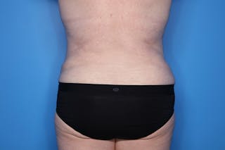 Tummy Tuck Before & After Gallery - Patient 268321 - Image 6
