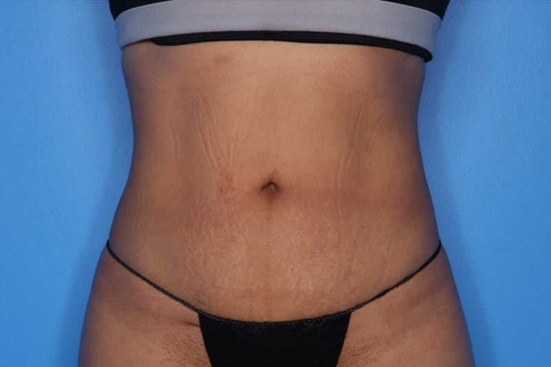BodyTite™ Before and After Before & After Gallery - Patient 258169 - Image 2