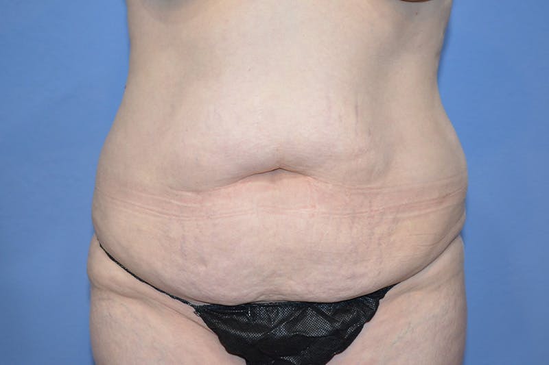 Tummy Tuck Before & After Gallery - Patient 268321 - Image 1