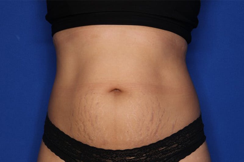 BodyTite™ Before and After Before & After Gallery - Patient 258169 - Image 1