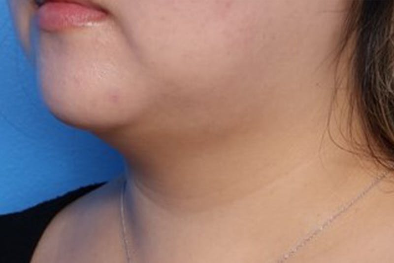 FaceTite Before and After Before & After Gallery - Patient 248896 - Image 4