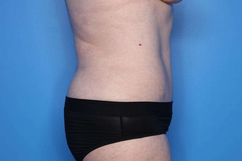 Tummy Tuck Before & After Gallery - Patient 268321 - Image 4