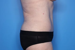 Tummy Tuck Before & After Gallery - Patient 268321 - Image 4