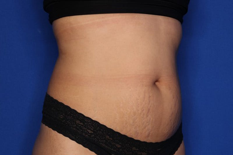 BodyTite™ Before and After Before & After Gallery - Patient 258169 - Image 3