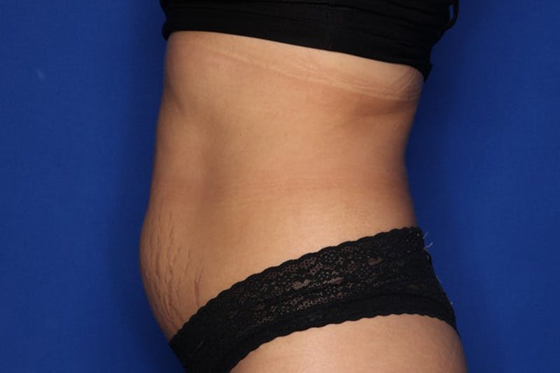 BodyTite™ Before and After Before & After Gallery - Patient 258169 - Image 5