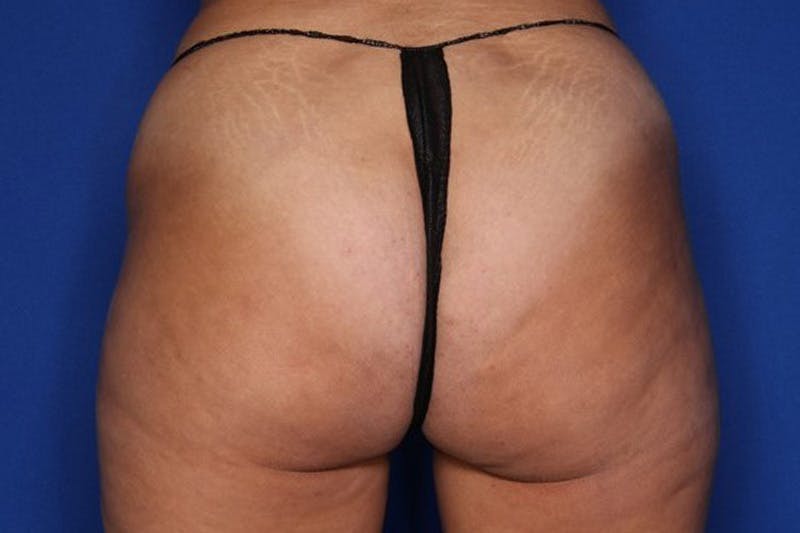 Liposuction Before & After Gallery - Patient 133045 - Image 1