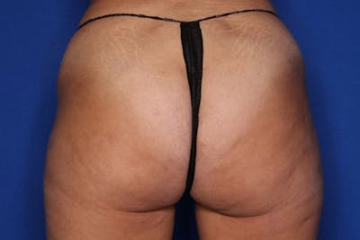 Liposuction Before & After Gallery - Patient 133045 - Image 1