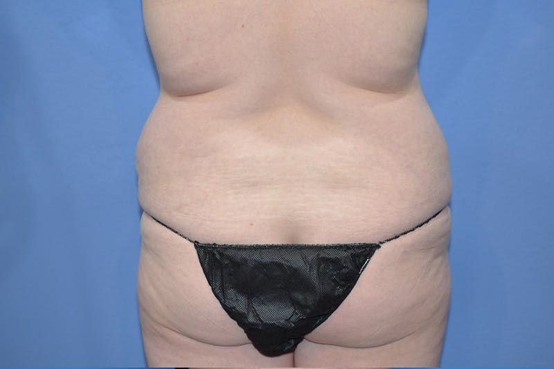 Tummy Tuck Before & After Gallery - Patient 268321 - Image 5