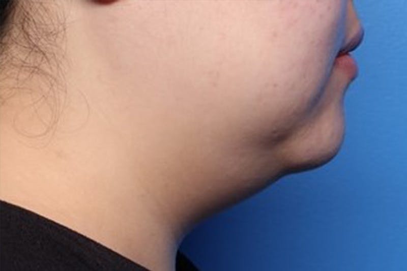 FaceTite Before and After Before & After Gallery - Patient 248896 - Image 1