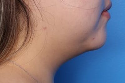 FaceTite Before and After Before & After Gallery - Patient 248896 - Image 2