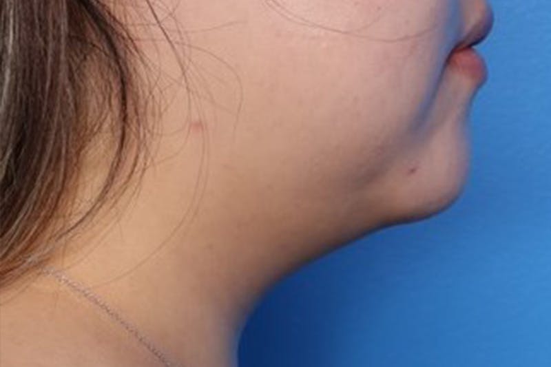 FaceTite Before and After Before & After Gallery - Patient 248896 - Image 2