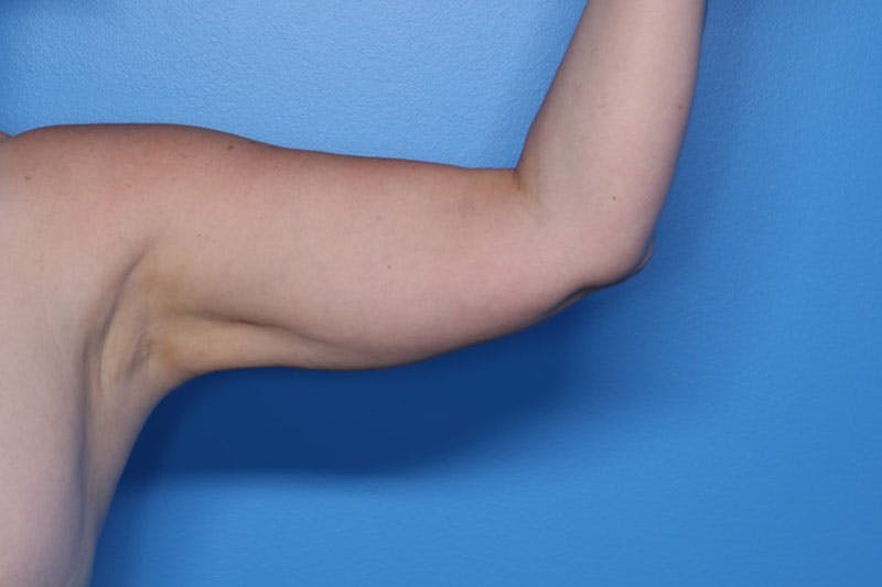 Liposuction Before & After Gallery - Patient 206676 - Image 4