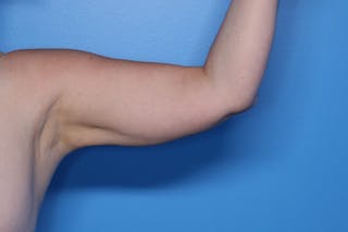 Liposuction Before & After Gallery - Patient 206676 - Image 4