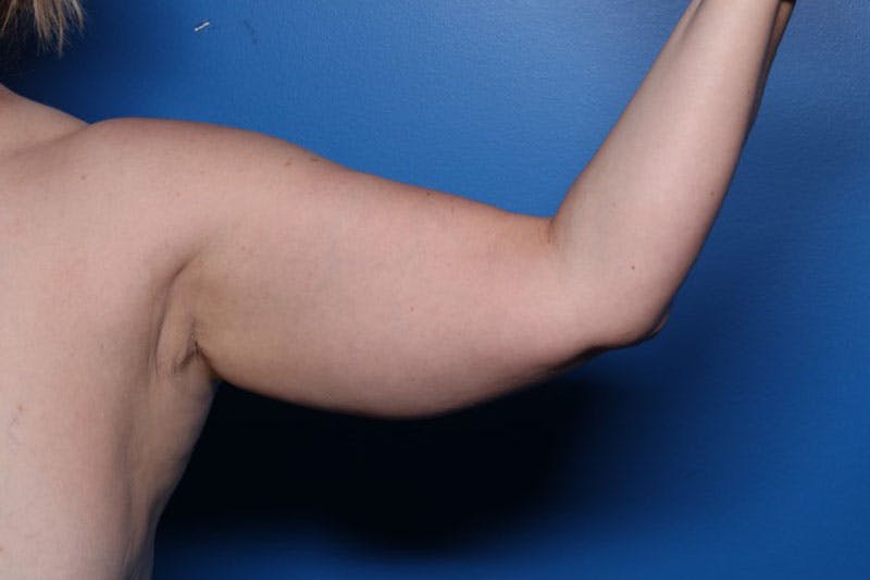 Liposuction Before & After Gallery - Patient 206676 - Image 3