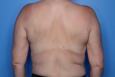 Liposuction Before & After Gallery - Patient 206676 - Image 2