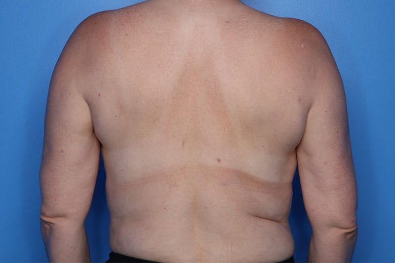 Liposuction Before & After Gallery - Patient 206676 - Image 2
