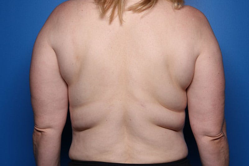 Liposuction Before & After Gallery - Patient 206676 - Image 1