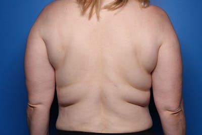 Liposuction Before & After Gallery - Patient 206676 - Image 1