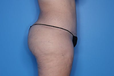 Brazilian Butt Lift Before & After Gallery - Patient 121200 - Image 2