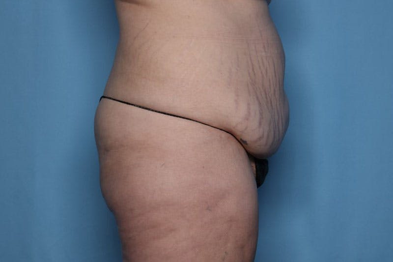 Body Lift Before & After Gallery - Patient 119570 - Image 3