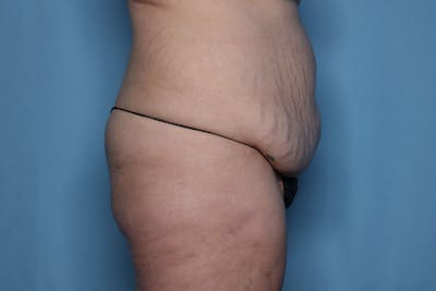 Brazilian Butt Lift Before & After Gallery - Patient 121200 - Image 1