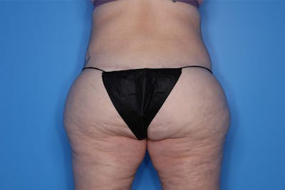 Body Lift Before & After Gallery - Patient 119570 - Image 2