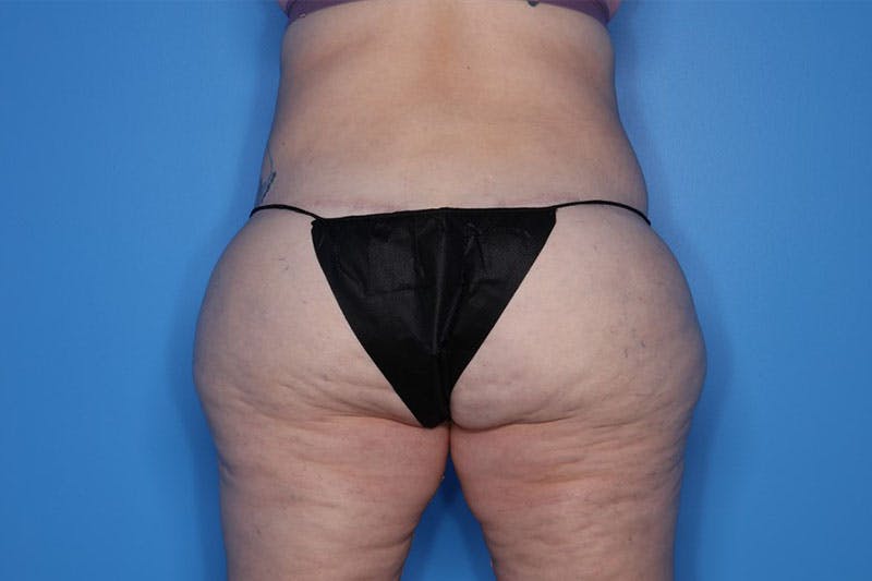 Body Lift Before & After Gallery - Patient 119570 - Image 2