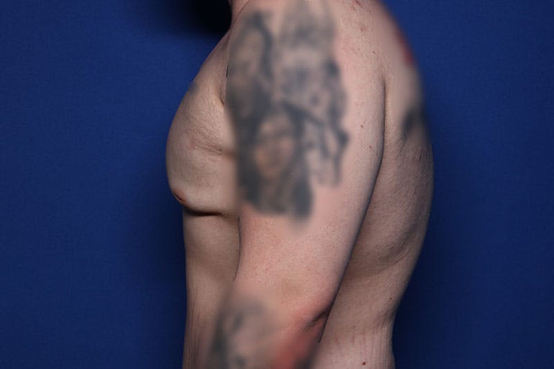 Body Lift Before & After Gallery - Patient 169846 - Image 3