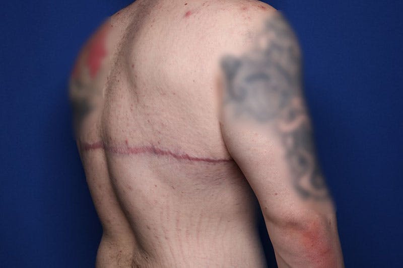 Body Lift Before & After Gallery - Patient 169846 - Image 6