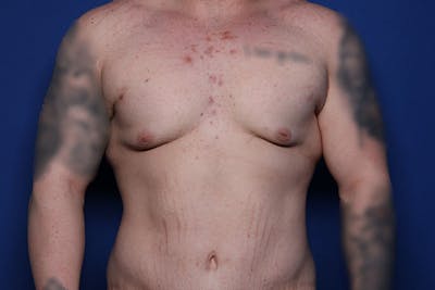 Body Lift Before & After Gallery - Patient 169846 - Image 1