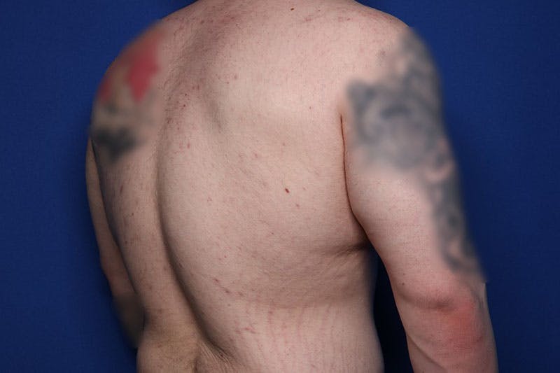 Body Lift Before & After Gallery - Patient 169846 - Image 5