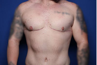 Body Lift Before & After Gallery - Patient 169846 - Image 2