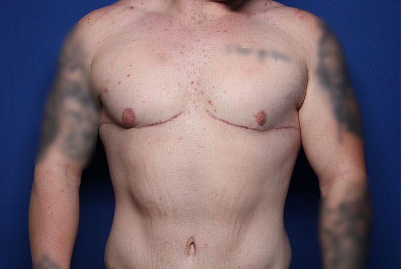 Body Lift Before & After Gallery - Patient 169846 - Image 2