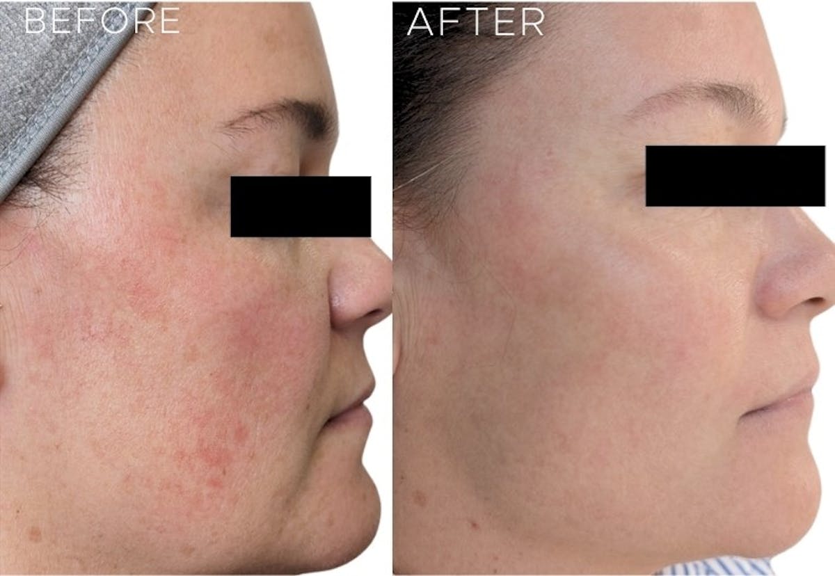 Sciton® BBL Hero Before & After Gallery - Patient 157560 - Image 1