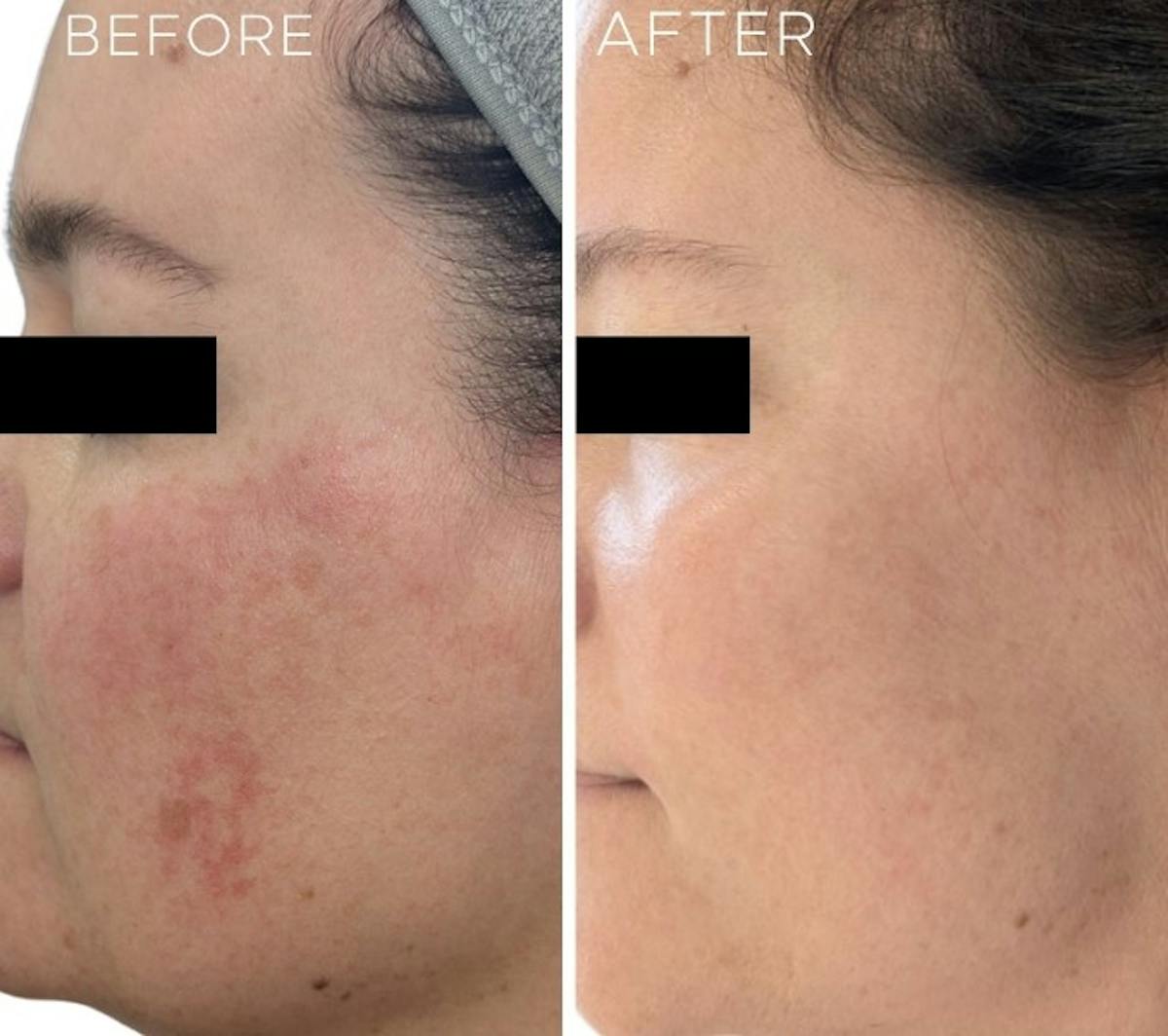 Sciton® BBL Hero Before & After Gallery - Patient 157560 - Image 2