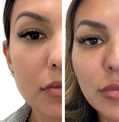 BOTOX Before & After Gallery - Patient 953051 - Image 1