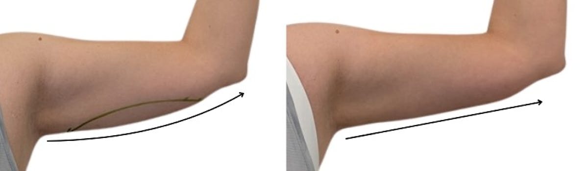 CoolSculpting® Before & After Gallery - Patient 416142 - Image 2