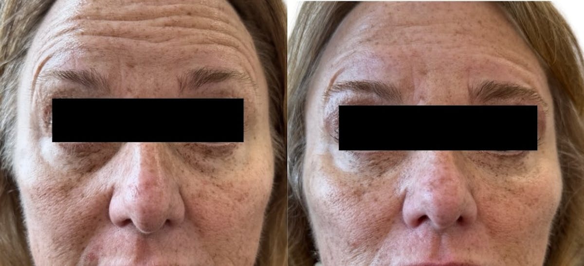 Juvéderm® Before & After Gallery - Patient 102915 - Image 1