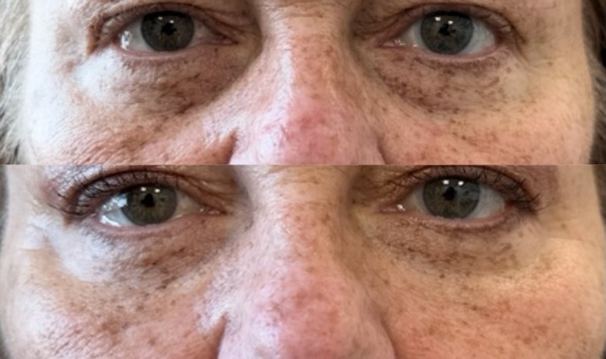 Juvéderm® Before & After Gallery - Patient 102915 - Image 2