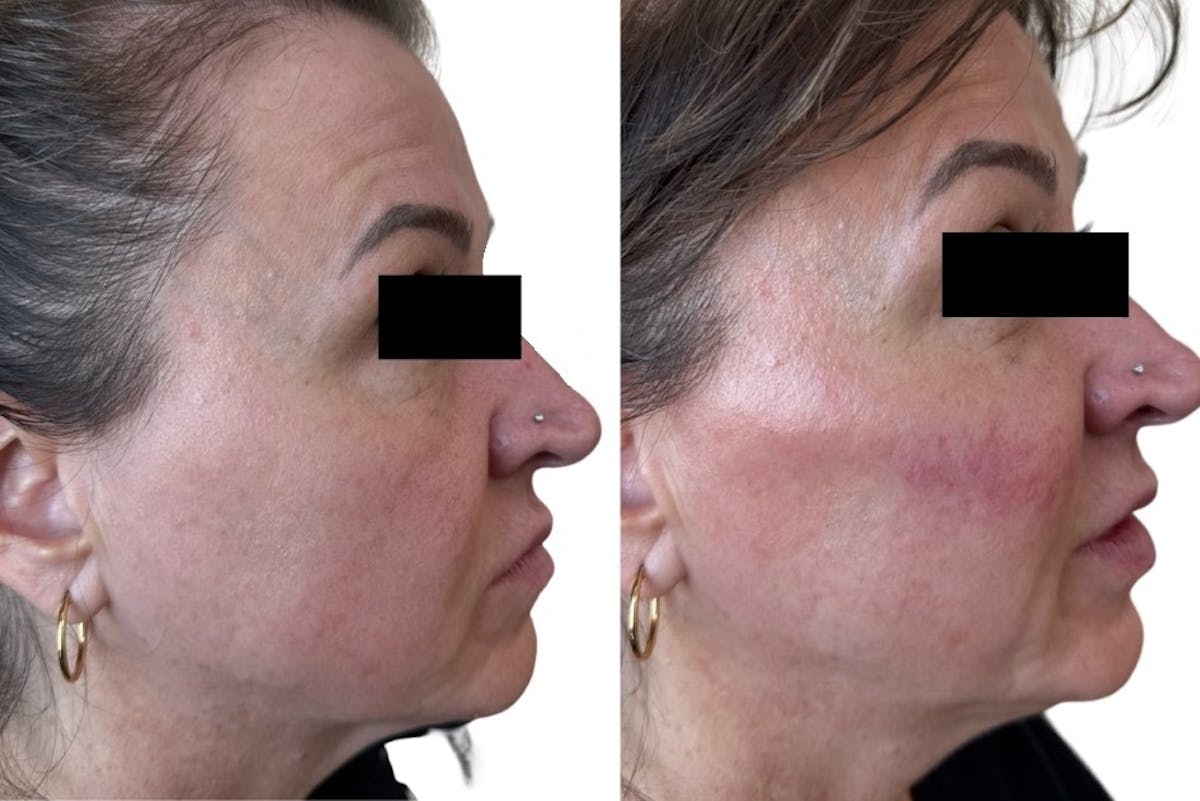 Cheek Filler Before & After Gallery - Patient 254549 - Image 2