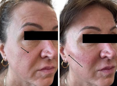 Juvéderm® Before & After Gallery - Patient 226673 - Image 1