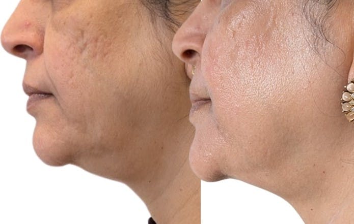 Morpheus8® Before & After Gallery - Patient 213952 - Image 2