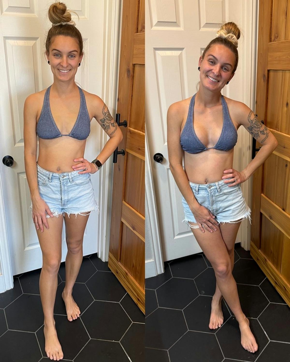 Patient Selfies Before & After Gallery - Patient 279143 - Image 1