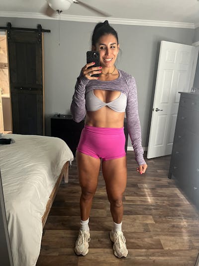 Patient Selfies Before & After Gallery - Patient 753958 - Image 1